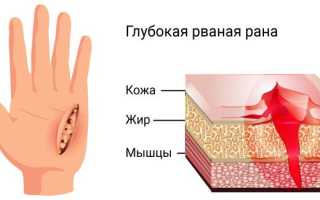 Как помочь пострадавшему с рваной раной