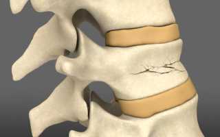 Лечение и восстановление после компрессионного перелома позвоночника в грудном отделе