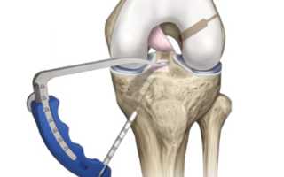 Артроскопия крестообразных связок коленного сустава