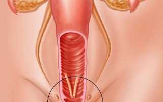 Рубцовые изменения на матке и шейке