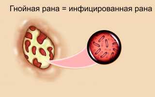 Обработка и лечение загноившейся раны