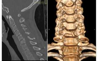 Лечение и последствия компрессионного перелома шейного отдела позвоночника