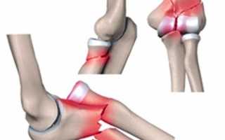Лечение перелома локтя и восстановительный период