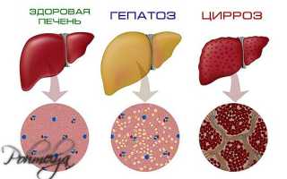 Современные методы лечения алкогольного гепатоза печени