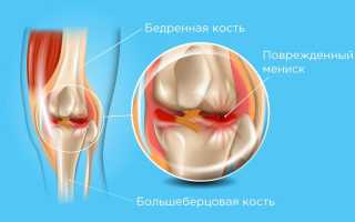 Что делать при разрыве мениска
